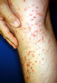 Fire ant stings on the leg of person who stepped on a fire ant mound