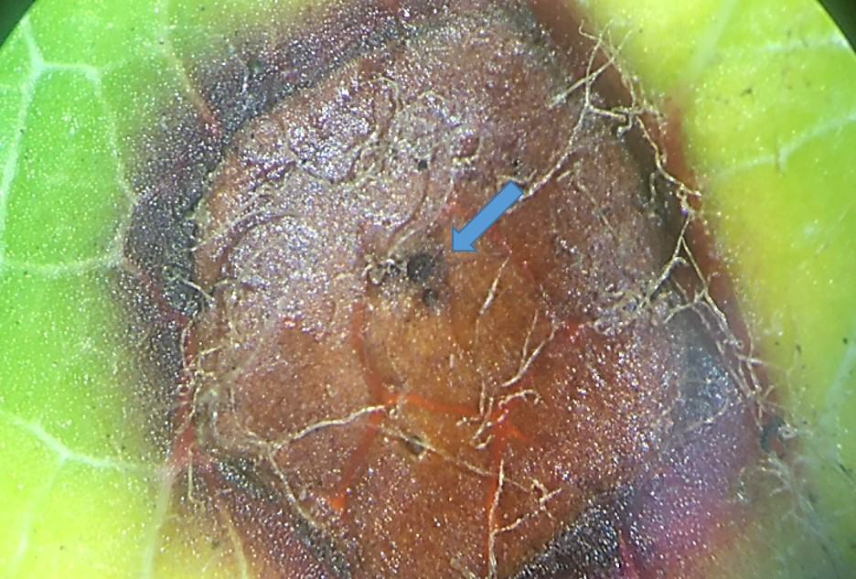 Close-up photo of an MLB lesion. Blue arrow is pointing to acervulus. 