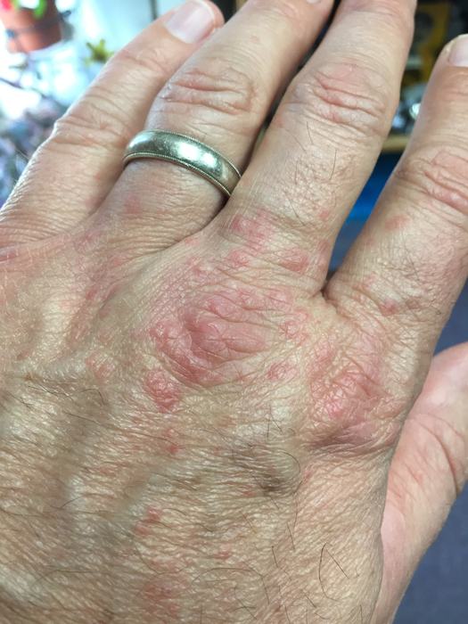 english ivy rash