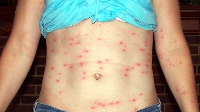 person with chigger bites on abdoman