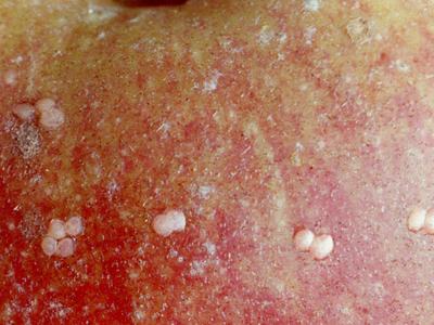 Codling moth eggs on apple