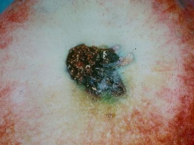 Lesser appleworm damage on apple