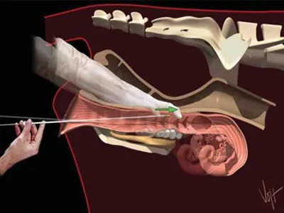 A hand demonstrates the act of artificial insemination. 