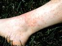 Chigger bites
