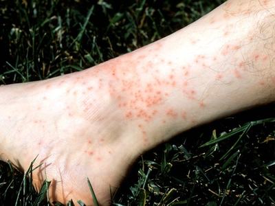 Chigger bites
