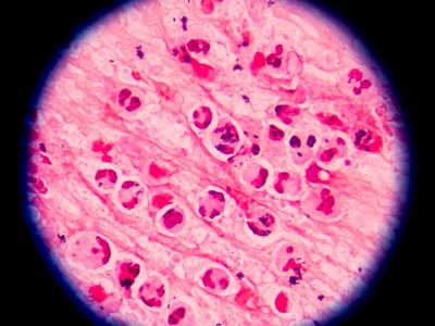 cyclospora