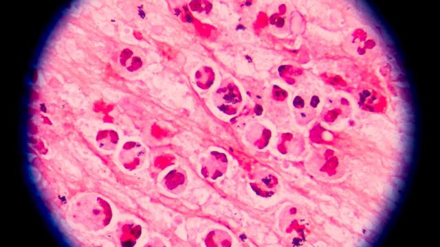 cyclospora